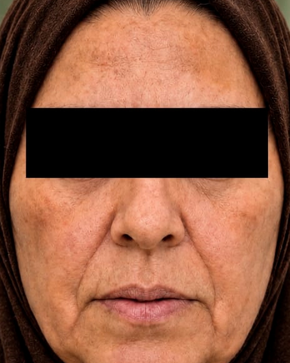 شد الوجه — منظر أمامي قبل — د. عبير الصياد
